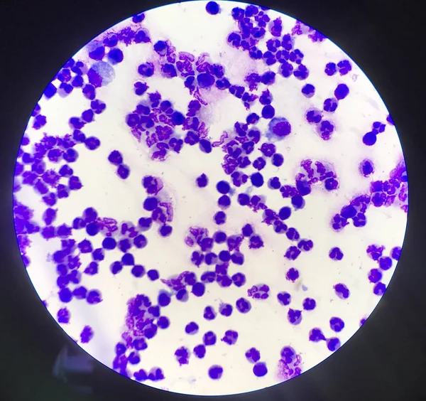 Grupo de células inflamatorias muestra de líquido ascítico . — Foto de Stock