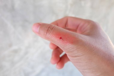 Arka planda kırmızı parmak yarası.