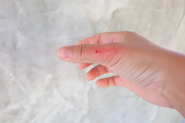 Herida roja en el dedo sobre fondo borroso . —  Fotos de Stock