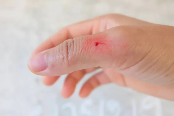 Rött sår i fingret på suddig bakgrund. — Stockfoto