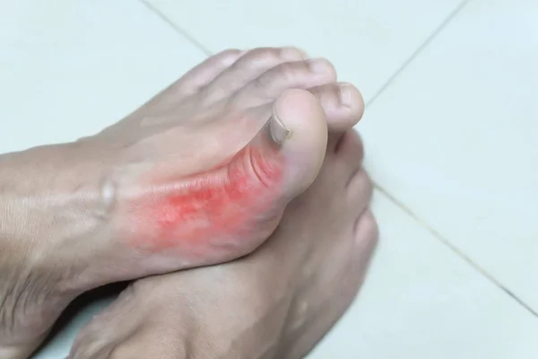 Foot of gout patient.Close up Painful and inflamed. — Stock Photo, Image