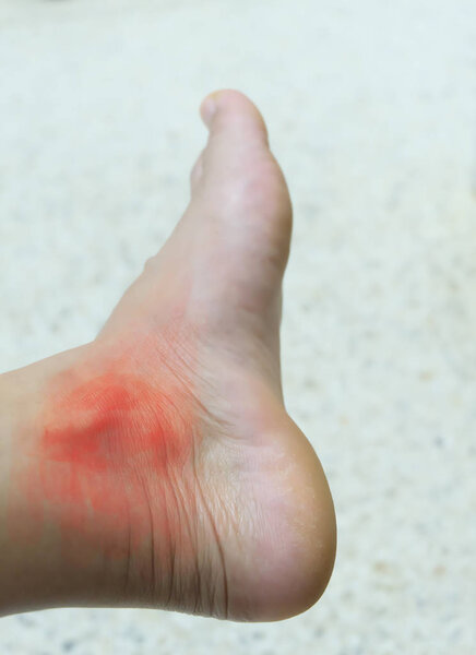 Foot of gout patient.Close up Painful and inflamed.