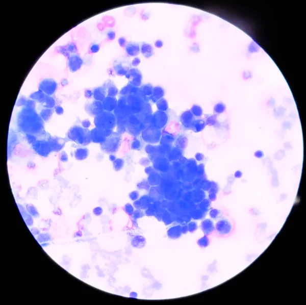 Rendellenes sejt többes folyadékban megtalálja mikroszkóppal. — Stock Fotó