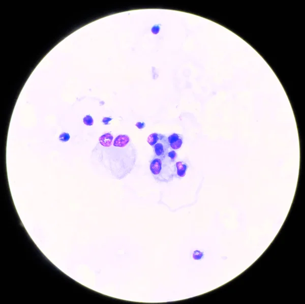 Abnormale cel in meervoud vloeistof vinden met microscoop. — Stockfoto