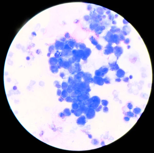 Célula anormal en líquido plural encontrada con microscopio . — Foto de Stock