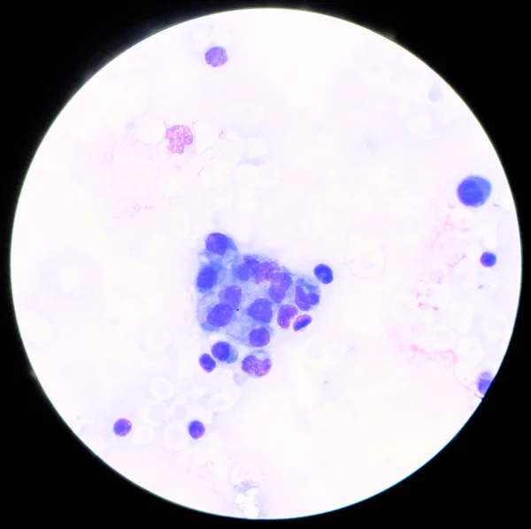 Nieprawidłowe komórki w liczbie mnogiej płynu znaleźć z mikroskopem. — Zdjęcie stockowe