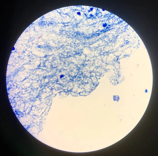 Mycobacterium tuberculosis köpetben pozitív 3+. — Stock Fotó