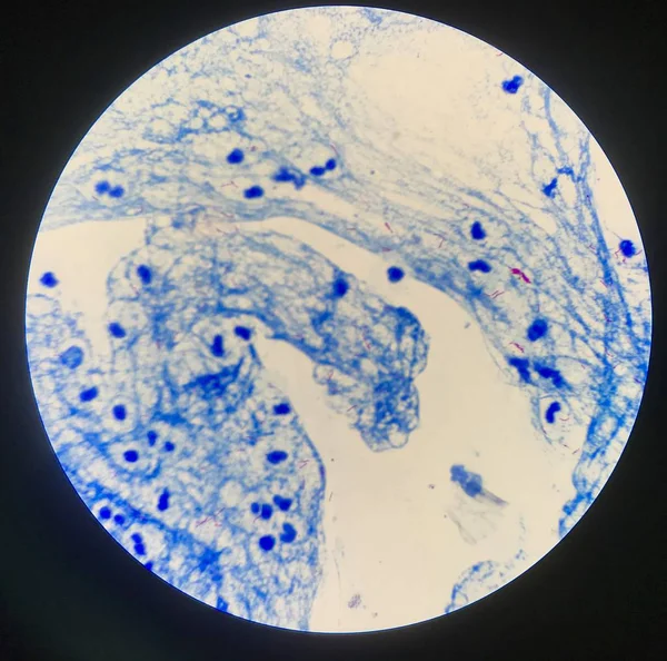 Tubercolosi micobatterica in Sputum positivo 3+. — Foto Stock
