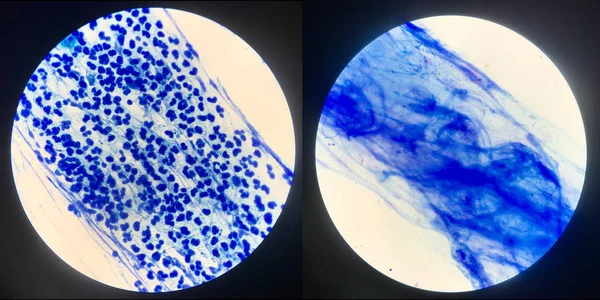 Auswurf-Abstrich für nachgewiesene Mykobakterien tuberculosis.left negati — Stockfoto