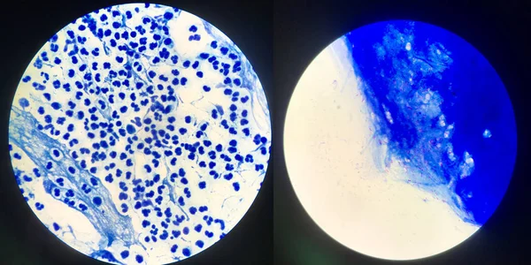 痰涂片检测结核分枝杆菌。左阴性 — 图库照片
