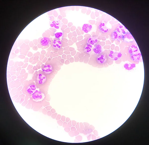 Нейтрофильные лейкоциты на фоне эритроцитов . — стоковое фото
