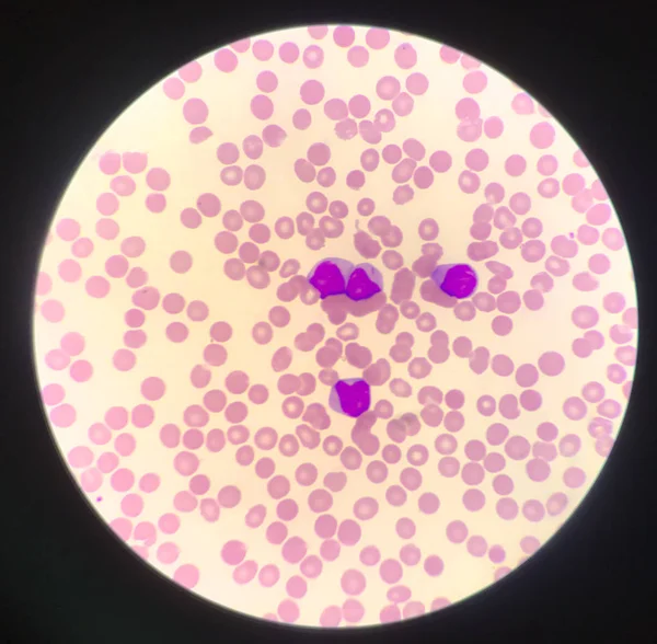 Leukémiás betegeknél éretlen sejt vagy hast sejt. — Stock Fotó