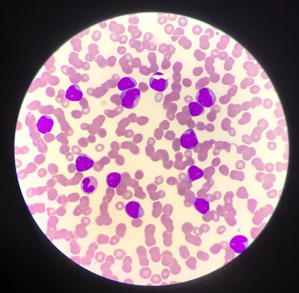 Незріла клітина або вибухова клітина в лейкемії патієнтів . — стокове фото