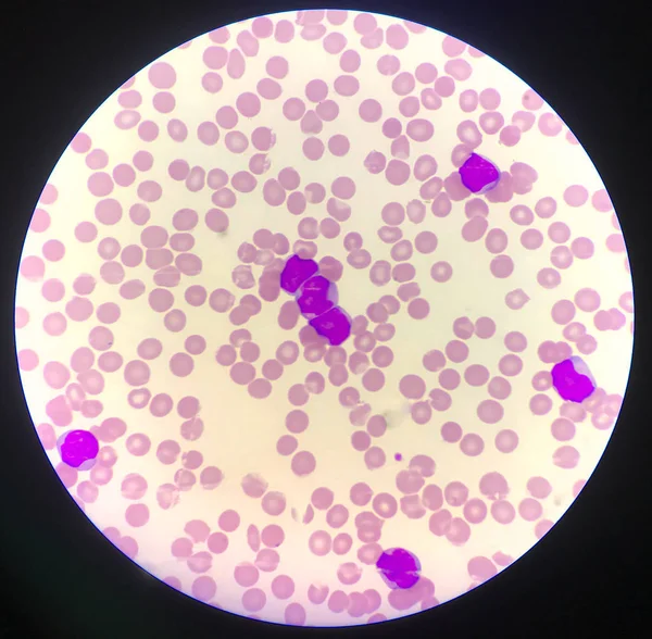 Células inmaduras o células bast en pacientes con leucemia . — Foto de Stock