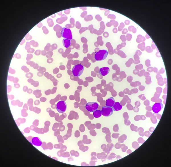 Zralé buňky nebo buňky bast u pacientů s leukémií. — Stock fotografie