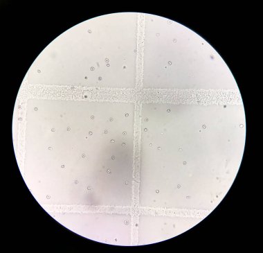 İdrar tortularında dismorfik kırmızı kan hücreleri.