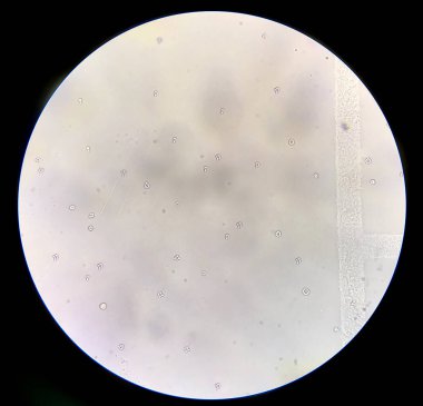 İdrar tortularında dismorfik kırmızı kan hücreleri.