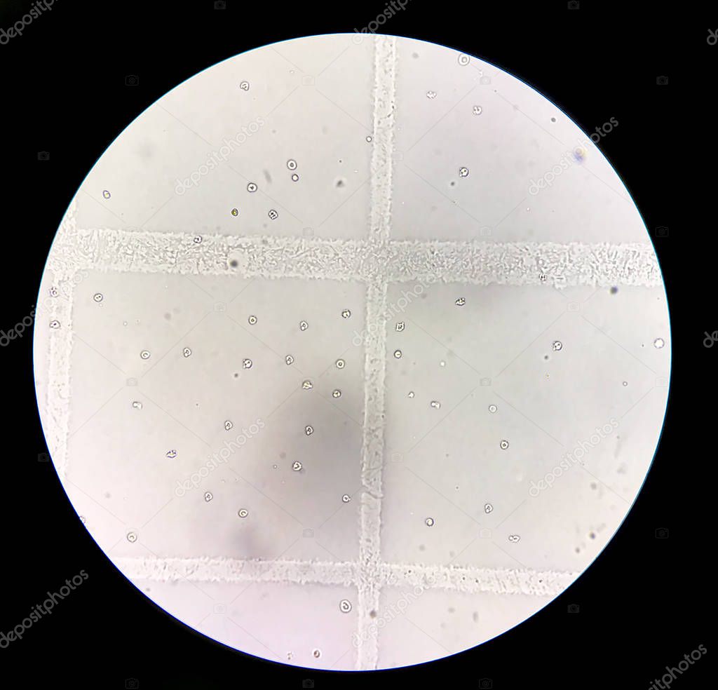 Dysmorphic red blood cells in urine sediment.