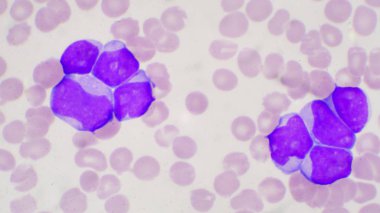 Blast cell in leukemia pateins in blood smear. clipart