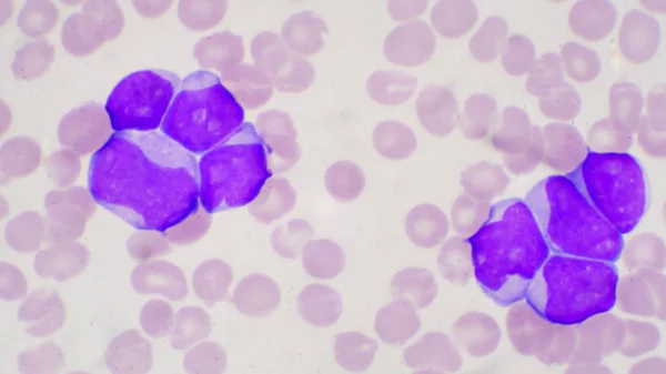 Blast cell in leukemia pateins in blood smear. — ストック写真