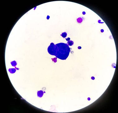 Plevral sıvıdaki anormal hücreler.