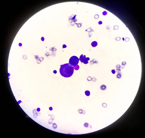 Células anormales en el líquido pleural . — Foto de Stock