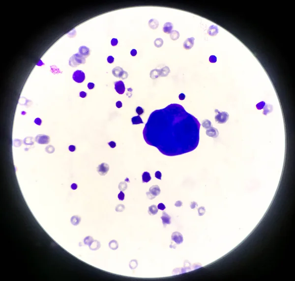 Abnormální buňky v pleurální tekutině. — Stock fotografie