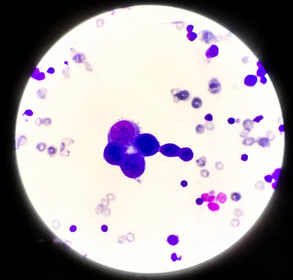 Cellule anormali nel liquido pleurico . — Foto Stock