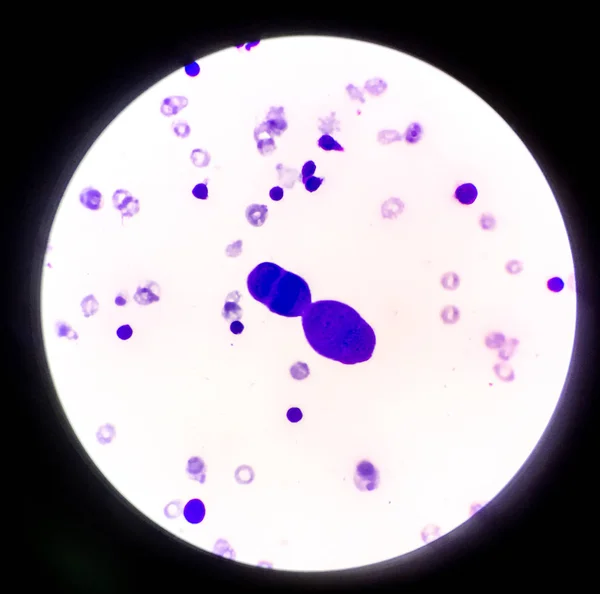 Аномальні клітини в плевральній рідині . — стокове фото