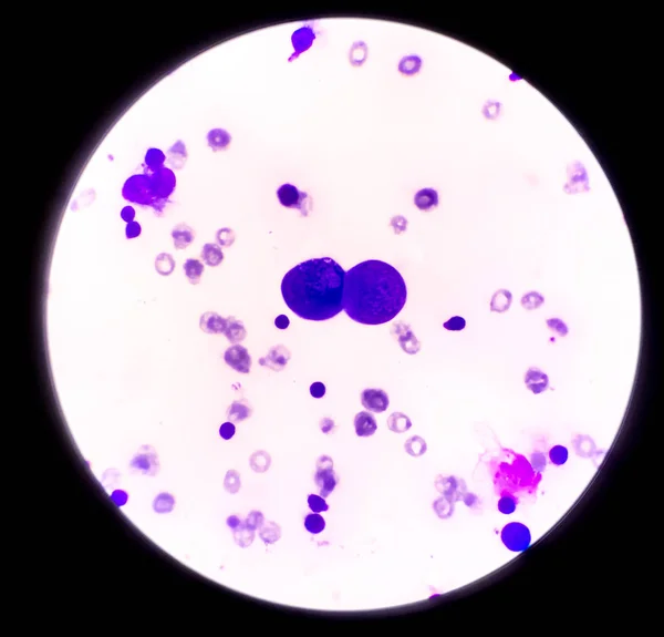 Аномальные клетки в плевральной жидкости . — стоковое фото