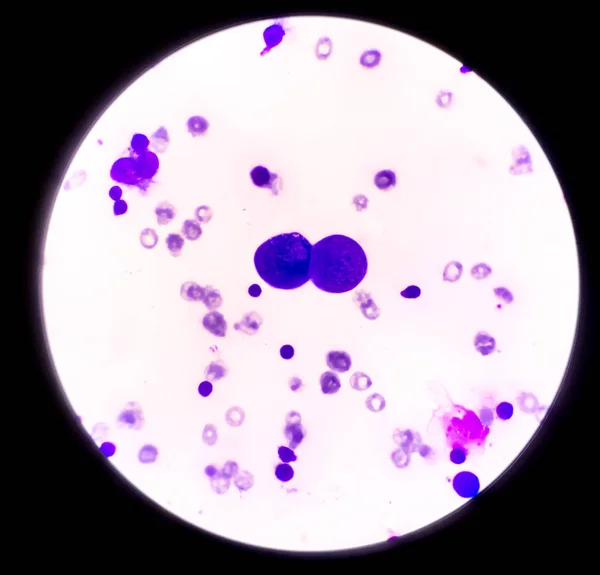 Abnormal cells in pleural fluid.