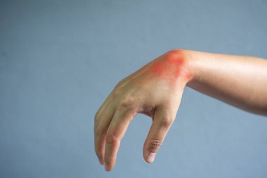 Gri arka plandaki gut hastasında el ağrısı var..