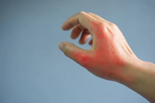 Închideți Mâna Dureroasă Pacientul Gută Fundal Gri — Fotografie, imagine de stoc