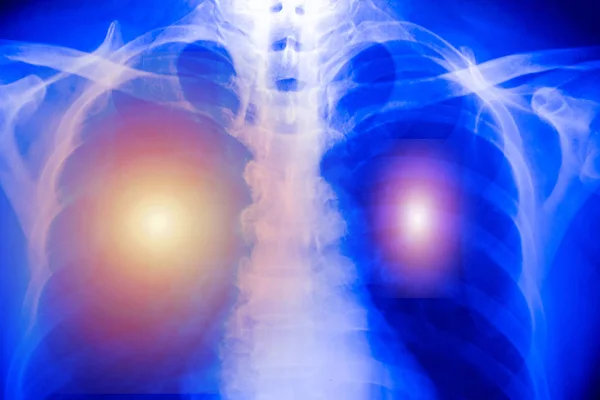 Рентген Грудной Клетки Пациента Повреждением Альвеол Инфицированный Коронавирус Ковид Концепции — стоковое фото
