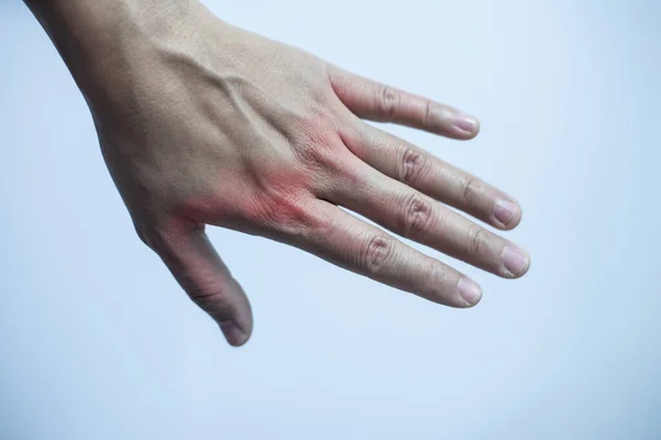 Bactérias Vírus Vermelho Mão Conceito Insalubre — Fotografia de Stock