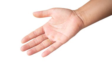 Tıbbi konseptte beyaz zemin üzerindeki el alerjisini kapat.