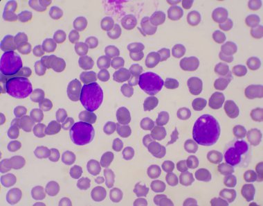 Immature white blood cells in blood smear leukemia concept. clipart
