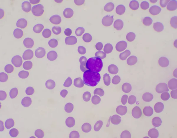 Immature White Blood Cells Blood Smear Leukemia Concept — Stock Photo, Image