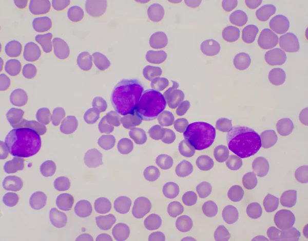 Glóbulos Blancos Inmaduros Concepto Leucemia Frotis Sangre — Foto de Stock
