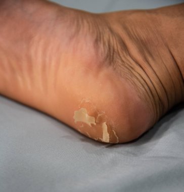 Close up foot of xerosis damage skin. clipart