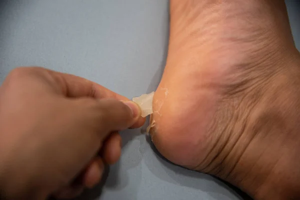 Close up foot of xerosis damage skin.