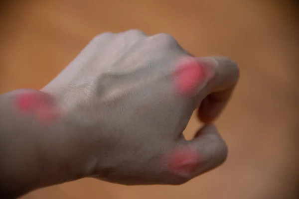 Κοντινό Χέρι Του Ασθενούς Ουρικής Αρθρίτιδας Θολό Φόντο — Φωτογραφία Αρχείου