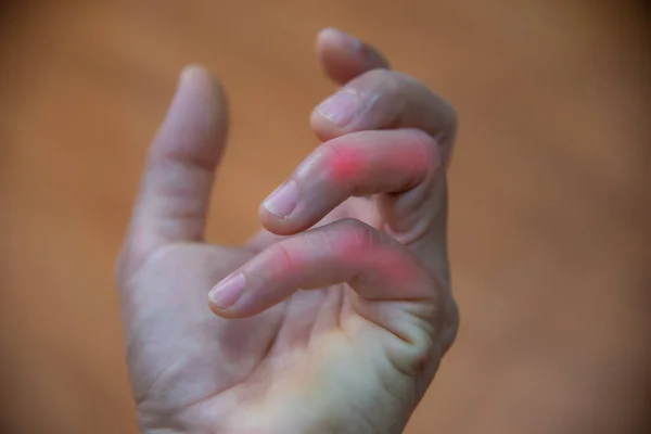 Cerca Mano Del Paciente Gota Fondo Borroso —  Fotos de Stock