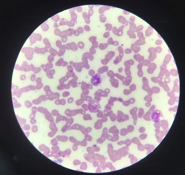 白血球における真菌感染 医学的背景 — ストック写真