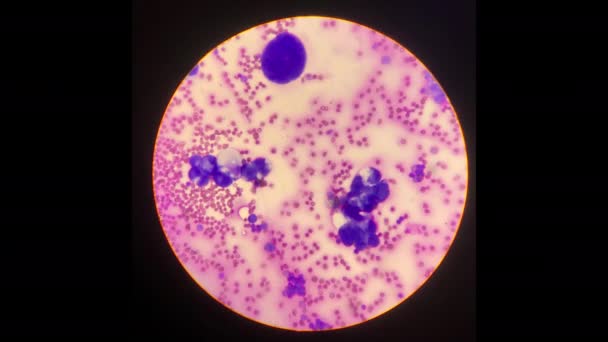 Atypical Cell Body Fluid Smear — Stock Video