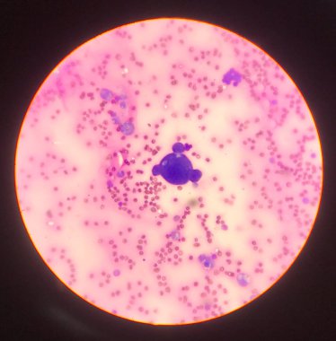 Vücut sıvısı yayılımındaki anormal hücreler. Laboratuvar bilim konsepti..