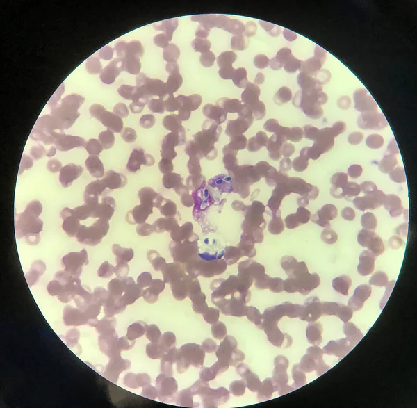 Fagocitosis Células Levadura Por Glóbulos Blancos Frotis Sanguínea Infección Por — Foto de Stock