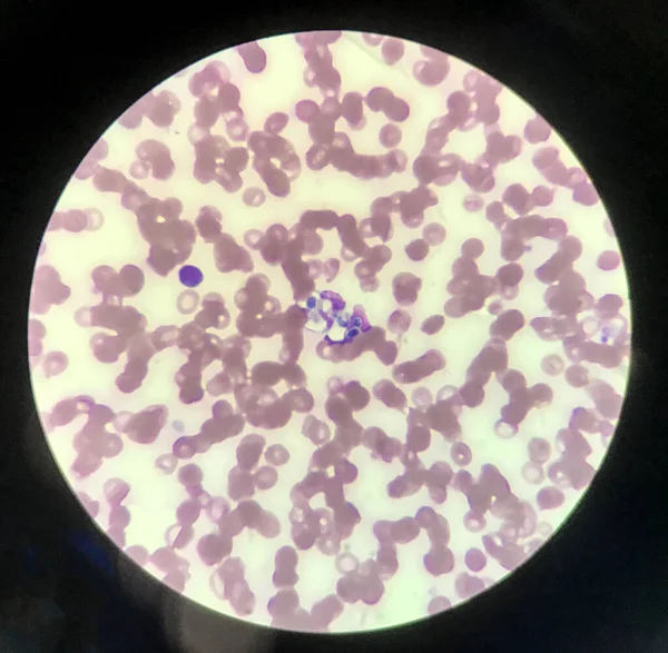 Yeast cells phagocytosis by white blood cell in blood smear.Fungus blood infection medical science background.