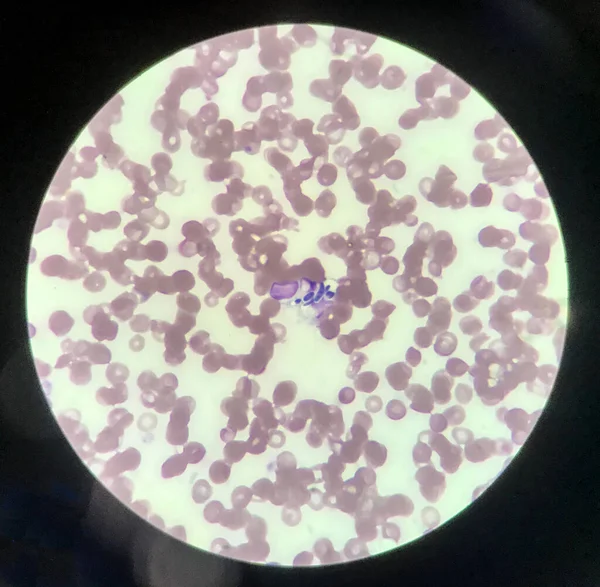 Yeast cells phagocytosis by white blood cell in blood smear.Fungus blood infection medical science background.