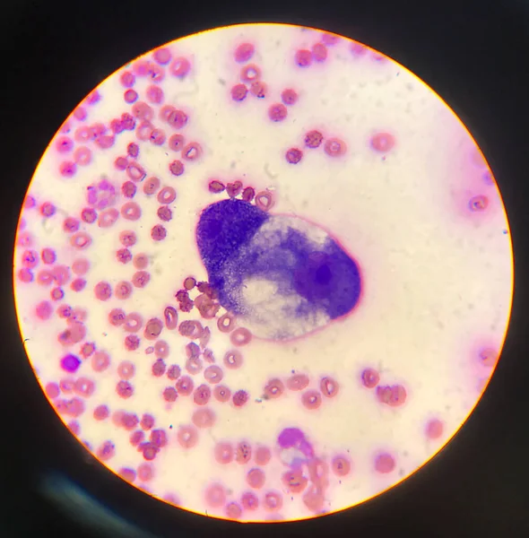 Atipikus Sejtek Testfolyadék Kenet Laboratóriumi Tudomány Koncepció — Stock Fotó